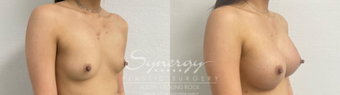 Before & After Breast Augmentation Case 887 Left Oblique View in Austin, TX