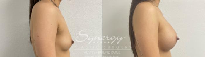 Before & After Breast Augmentation Case 887 Left Side View in Austin, TX