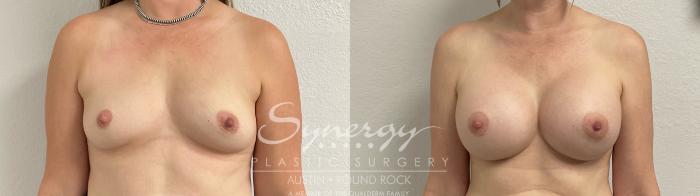 Before & After Breast Augmentation Case 889 Front View in Austin, TX