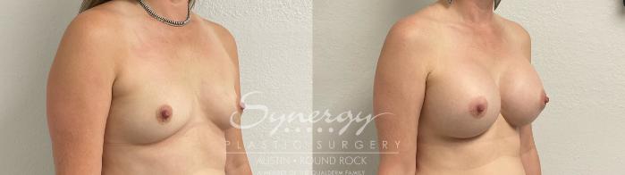 Before & After Breast Augmentation Case 889 Left Oblique View in Austin, TX