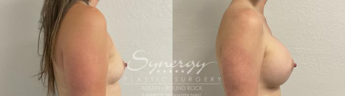 Before & After Breast Augmentation Case 889 Left Side View in Austin, TX