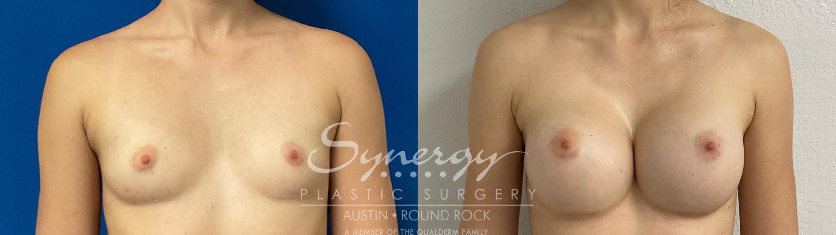 Before & After Breast Augmentation Case 895 Front View in Austin, TX