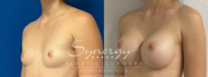 Before & After Breast Augmentation Case 895 Left Oblique View in Austin, TX