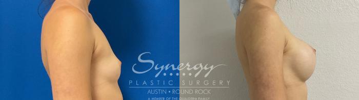 Before & After Breast Augmentation Case 895 Right Side View in Austin, TX