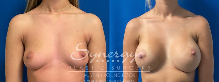 Before & After Breast Augmentation Case 906 Front View in Austin, TX