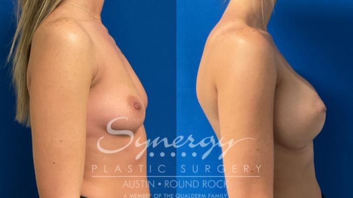 Before & After Breast Augmentation Case 906 Right Side View in Austin, TX