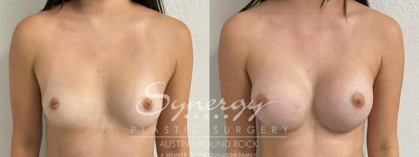 Before & After Breast Augmentation Case 908 Front View in Austin, TX