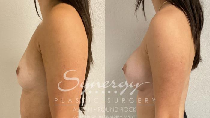 Before & After Breast Augmentation Case 908 Left Side View in Austin, TX