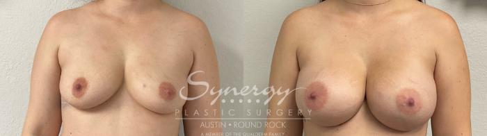 Before & After Breast Augmentation Case 917 Front View in Austin, TX