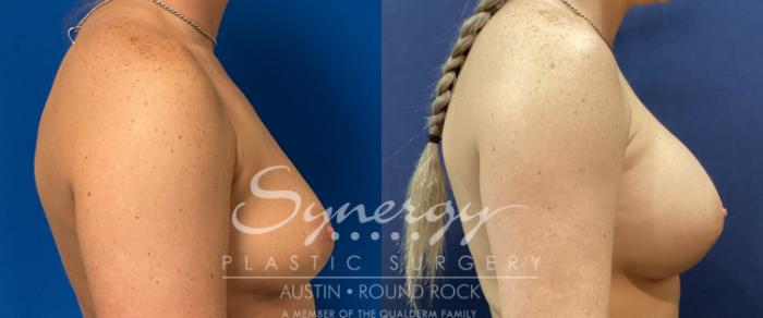 Before & After Breast Augmentation Case 923 Left Side View in Austin, TX