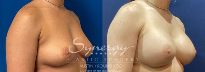 Before & After Breast Augmentation Case 923 Right Side View in Austin, TX