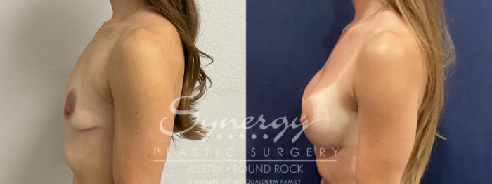 Before & After Breast Augmentation Case 931 Left Side View in Austin, TX