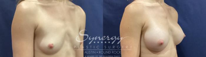 Before & After Breast Augmentation Case 934 Right Oblique View in Austin, TX