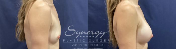 Before & After Breast Augmentation Case 934 Right Side View in Austin, TX