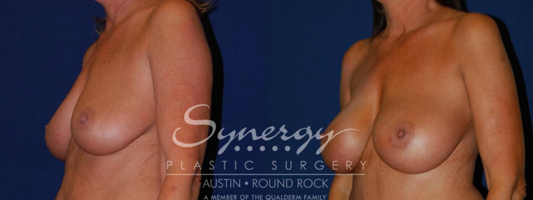 Before & After Breast Augmentation Case 94 View #1 View in Austin, TX