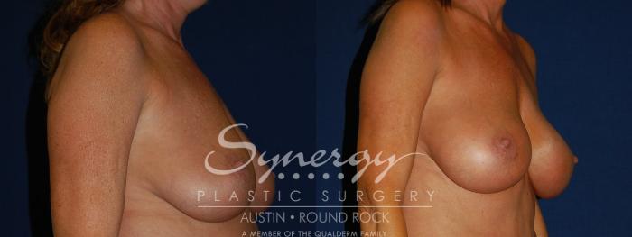 Before & After Breast Augmentation Case 94 View #2 View in Austin, TX