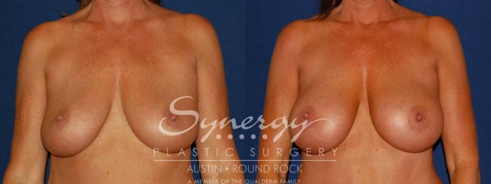Before & After Breast Augmentation Case 94 View #3 View in Austin, TX