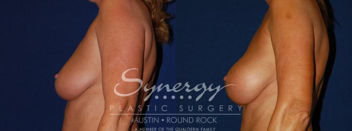 Before & After Breast Augmentation Case 94 View #4 View in Austin, TX