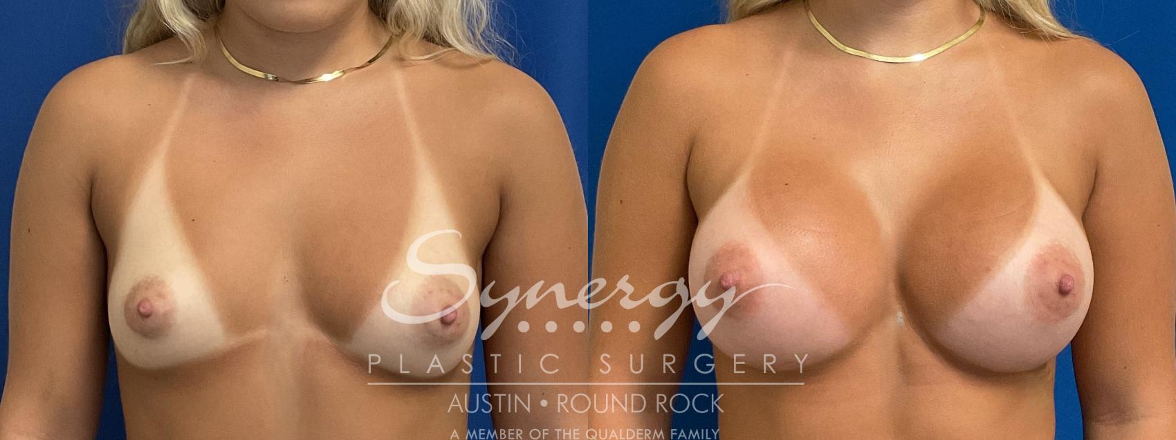 Before & After Breast Augmentation Case 940 Front View in Austin, TX