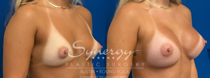 Before & After Breast Augmentation Case 940 Right Oblique View in Austin, TX