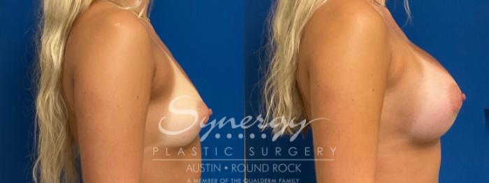 Before & After Breast Augmentation Case 940 Right Side View in Austin, TX