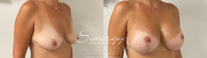 Before & After Breast Augmentation Case 943 Right Oblique View in Austin, TX