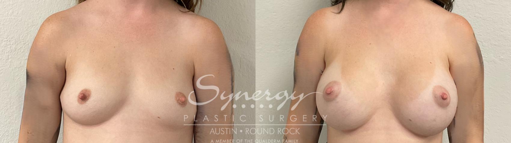 Before & After Breast Augmentation Case 945 Front View in Austin, TX
