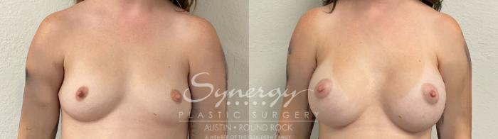 Before & After Breast Augmentation Case 945 Front View in Austin, TX