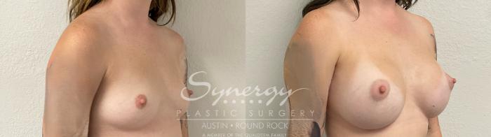 Before & After Breast Augmentation Case 945 Right Oblique View in Austin, TX