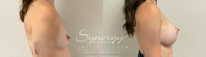 Before & After Breast Augmentation Case 945 Right Side View in Austin, TX