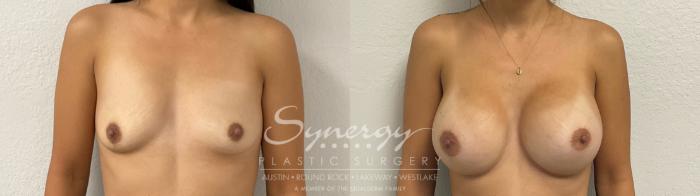 Before & After Breast Augmentation Case 951 Front View in Austin, TX