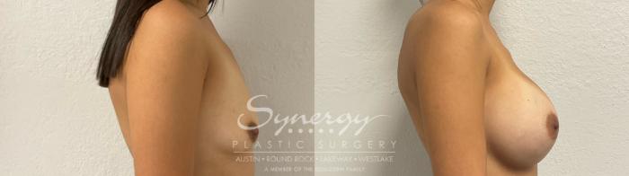 Before & After Breast Augmentation Case 951 Right Side View in Austin, TX