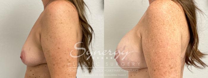 Before & After Breast Augmentation Case 952 Left Side View in Austin, TX