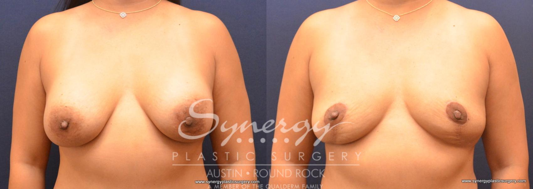 Before & After Breast Implant Removal Case 704 View #1 View in Austin, TX