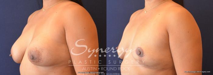 Before & After Breast Implant Removal Case 704 View #2 View in Austin, TX