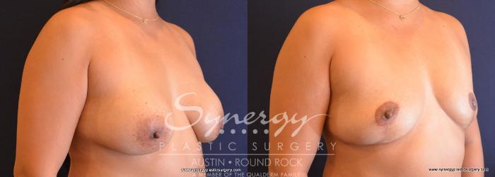 Before & After Breast Implant Removal Case 704 View #3 View in Austin, TX