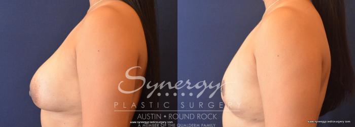 Before & After Breast Implant Removal Case 704 View #4 View in Austin, TX