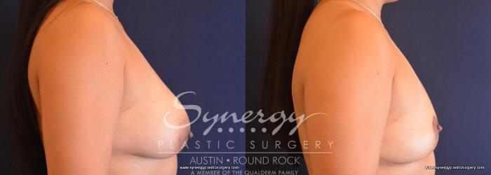 Breast Implant Removal Before and After Pictures Case 25, Little Rock,  Arkansas