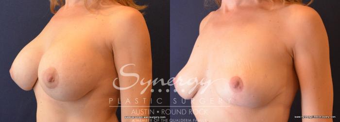 Before & After Breast Implant Removal Case 708 View #2 View in Austin, TX