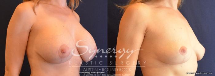 Before & After Breast Implant Removal Case 708 View #4 View in Austin, TX
