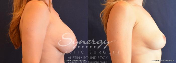 Before & After Breast Implant Removal Case 708 View #5 View in Austin, TX