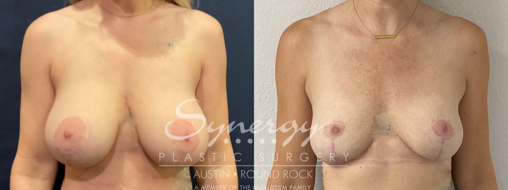 Before & After Breast Implant Removal Case 859 Front View in Austin, TX