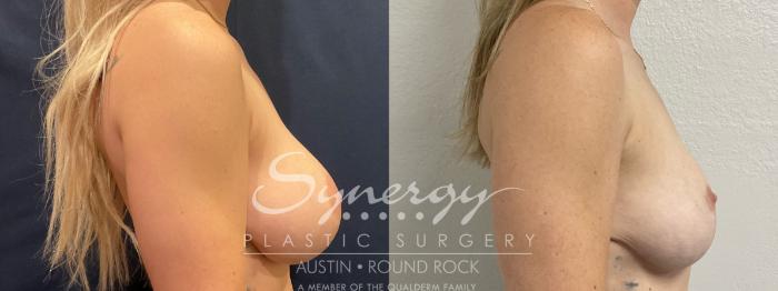 Before & After Breast Lift (Mastopexy) Case 859 Left Oblique View in Austin, TX