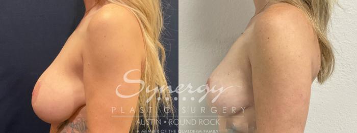 Before & After Breast Implant Removal Case 859 Right Side View in Austin, TX