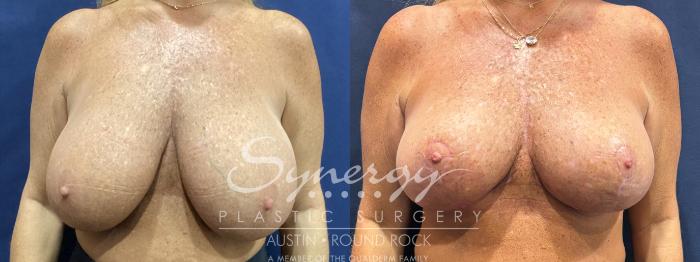 Before & After Breast Implant Removal Case 900 Front View in Austin, TX