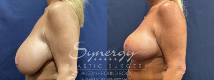 Before & After Breast Implant Removal Case 900 Left Side View in Austin, TX