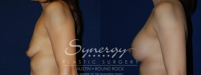 Before & After Breast Lift & Breast Augmentation Case 116 View #1 View in Austin, TX