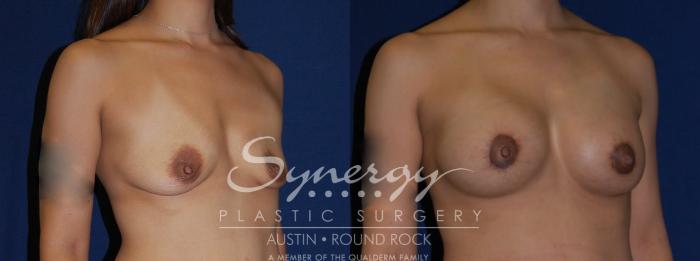 Before & After Breast Lift & Breast Augmentation Case 116 View #3 View in Austin, TX