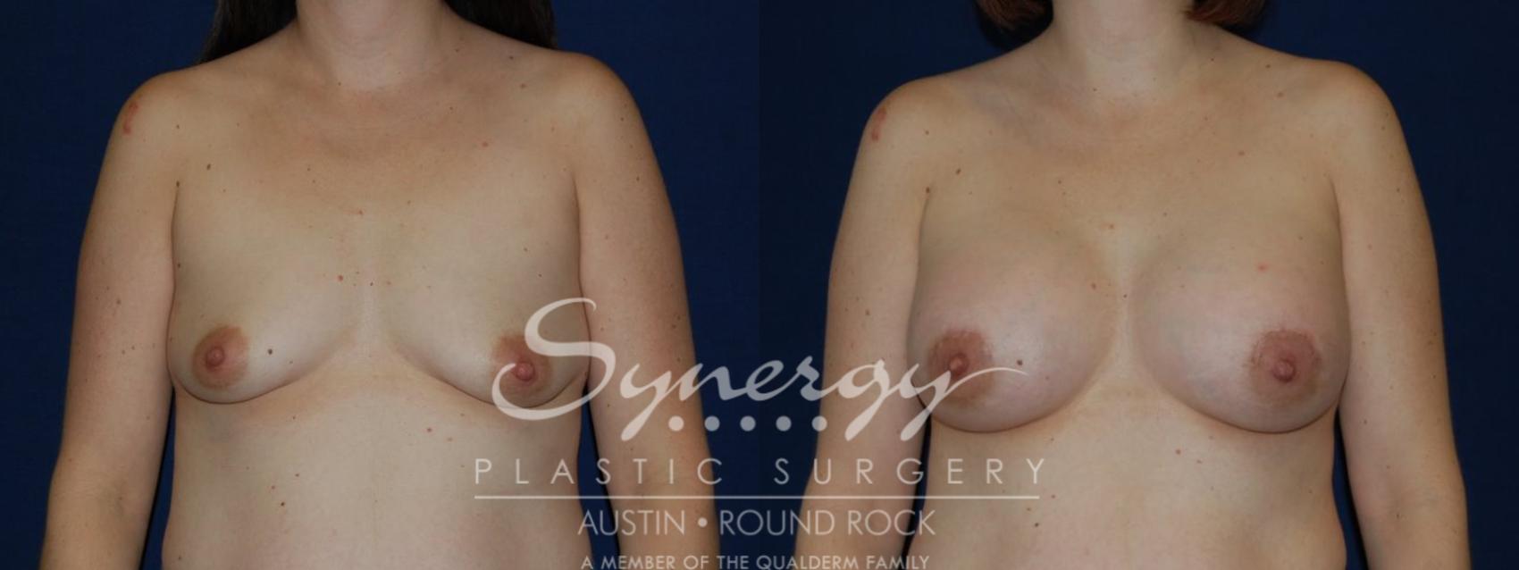 Before & After Breast Lift & Breast Augmentation Case 132 View #1 View in Austin, TX