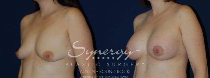 Before & After Breast Lift & Breast Augmentation Case 132 View #2 View in Austin, TX